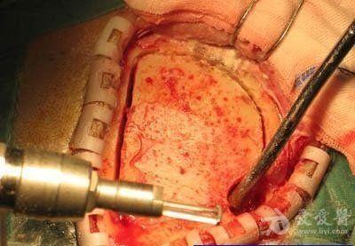 开颅手术一般需要用什么器材?