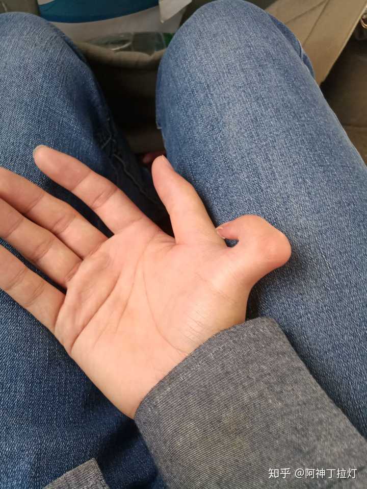 一只手有六个手指是种怎样的体验?