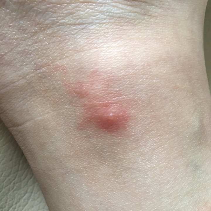 脚踝很痒出现了红色的肿块中间还有个透明凸起的小疙瘩应该不是蚊子吧